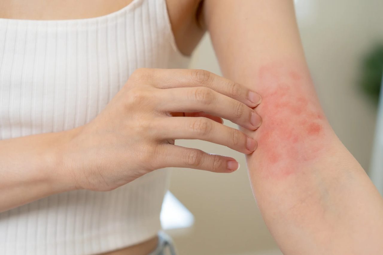 What Eczema Actually Is