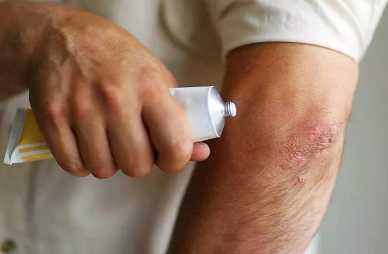 What Most People Get Wrong About Eczema and When to See a Specialist